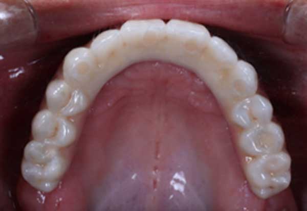All-on-4-Implants-in-the-mouth.-No-palatal-extension-and-no-flange.-Ensuring-maximum-comfort-for-chewing-and-tasting-foods.-1