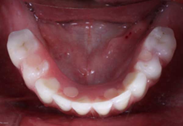 All-on-4-Implants-in-the-mouth.-No-palatal-extension-and-no-flange.-Ensuring-maximum-comfort-for-chewing-and-tasting-foods.-2