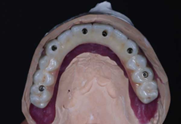 All-on-4-Implants-on-the-laboratory-made-models-showing-zero-flange-and-no-palatal-extension.-1