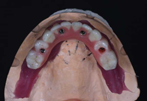 All-on-4-Implants-on-the-laboratory-made-models-showing-zero-flange-and-no-palatal-extension.-2