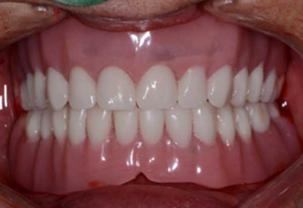 Full-dentures-Large-flange-needed-to-support-dentures