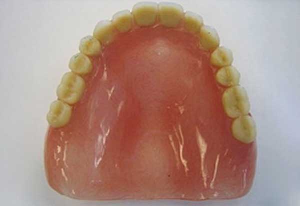 Full-dentures-require-extension-onto-our-palate-for-support