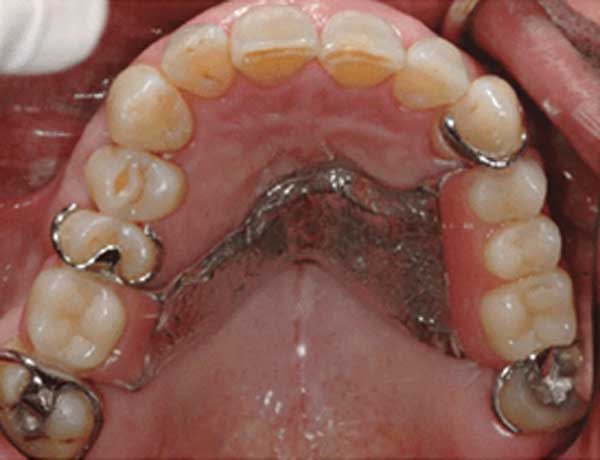 Removable-partial-dentures-as-an-option-2