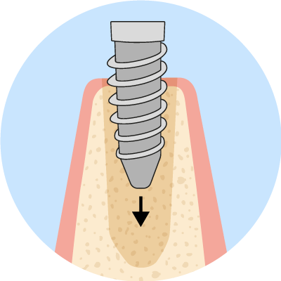 QLD-Dental-Implant-2-Right