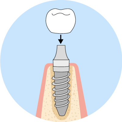 QLD-Dental-Implant-5-Right