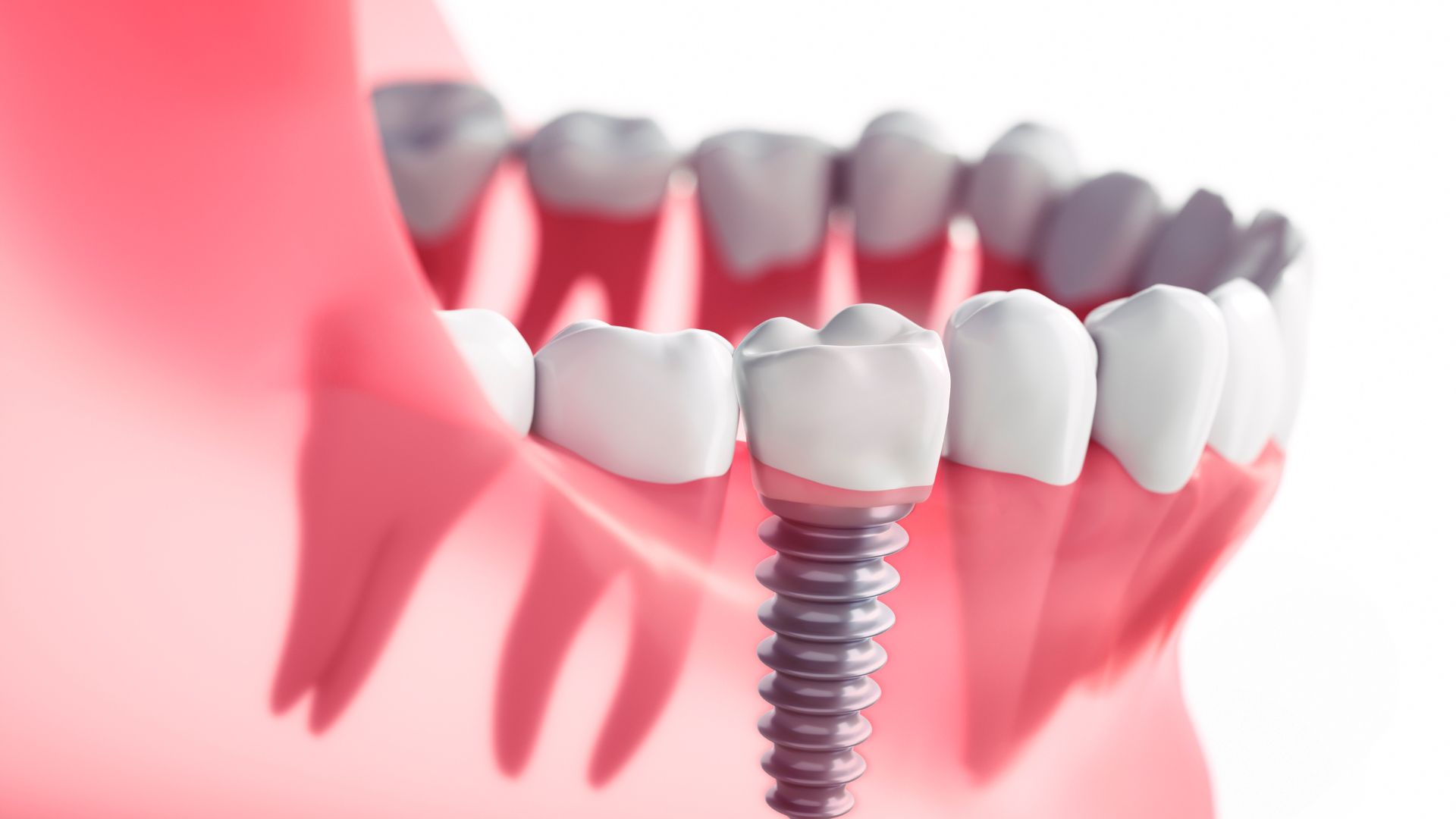 Do I Need All-on-4 Implants? Assessing Your Eligibility
