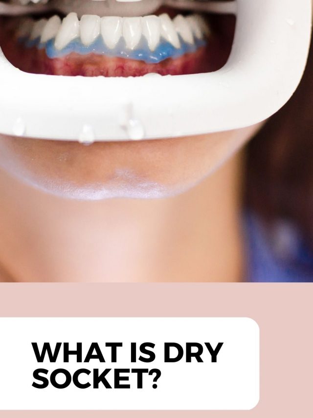 What is dry socket?
